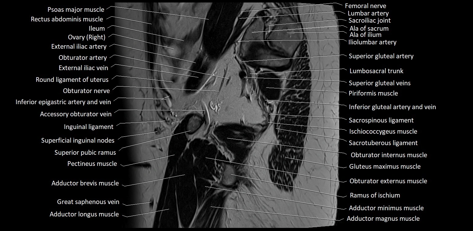 Sagittal cross sectional anatomy of female pelvis (MRI 3T) image 7.webp